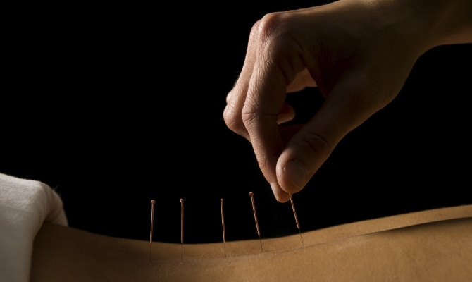 Agopuntura: un toccasana per la linea
