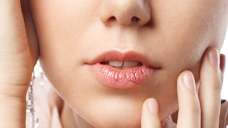 Labbra secche: ecco come prendersene cura
